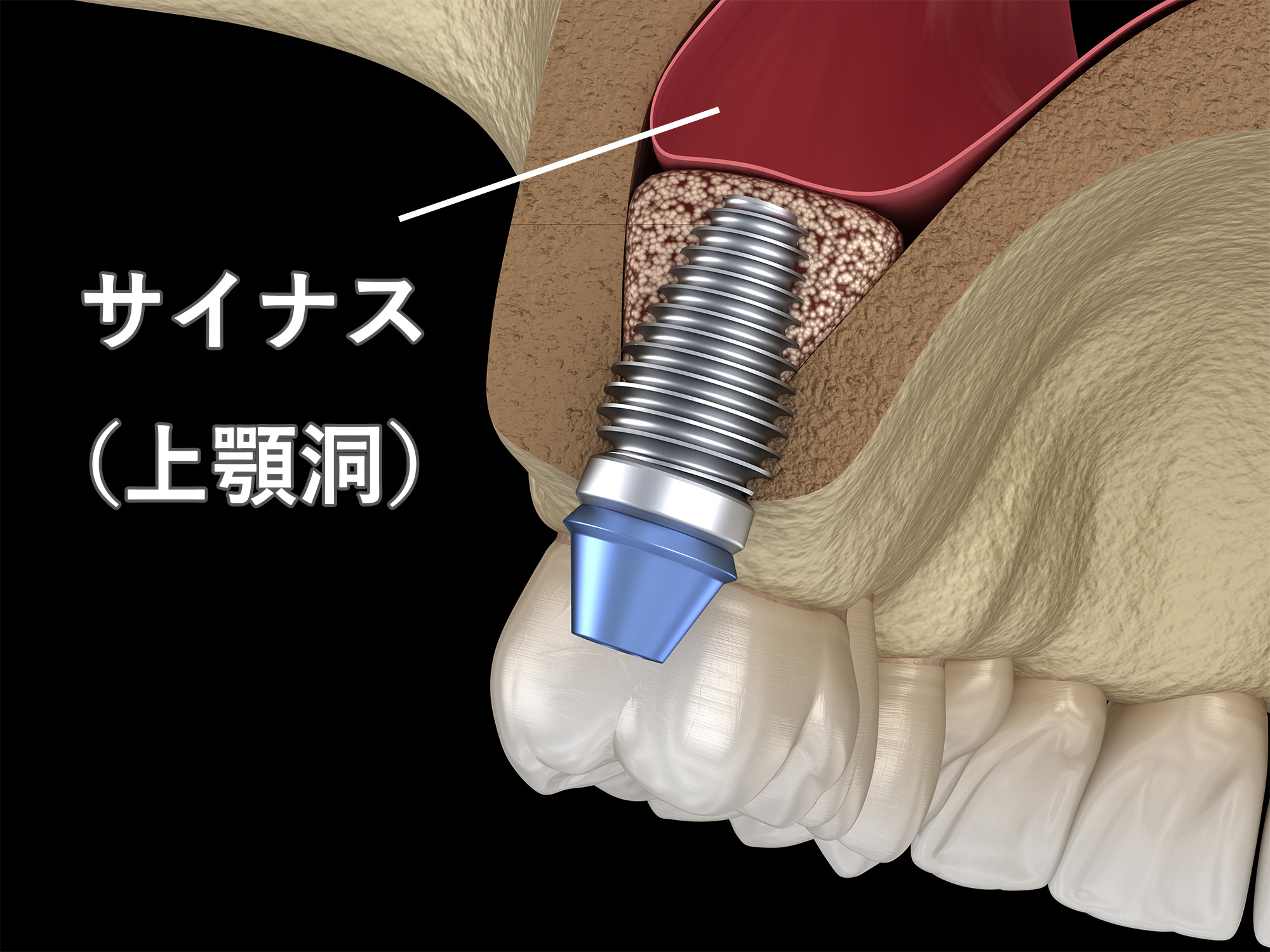 サイナスリフト